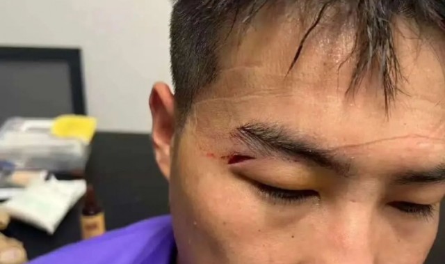 津媒：王献钧两颗门牙被撞断，杨帆眉骨受伤赛后去医院缝针